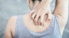 Kako odstraniti srbenje po ugrizu